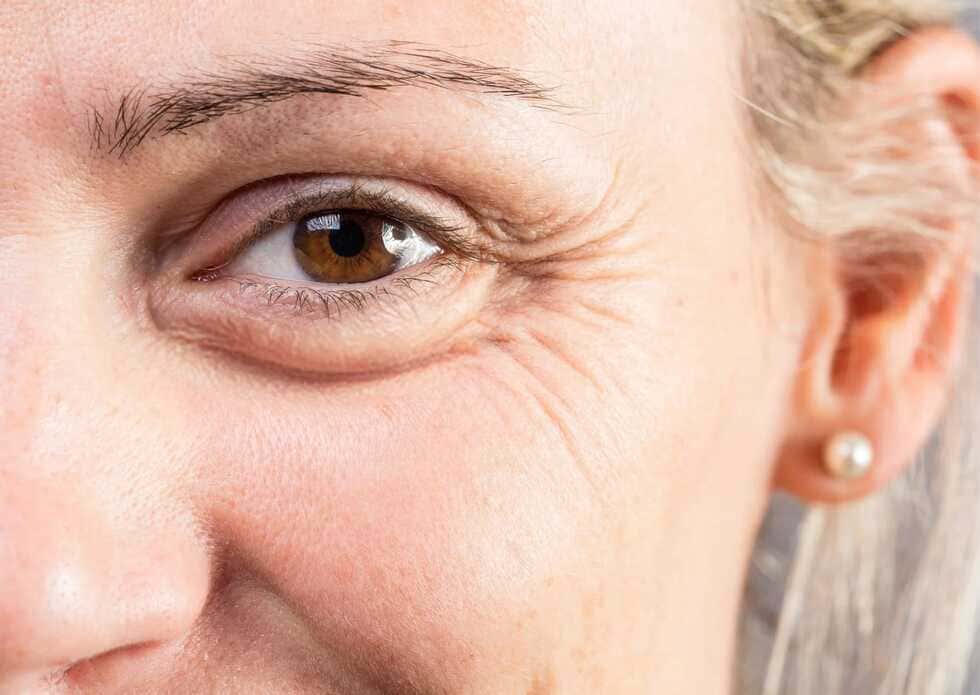 Mujer en primer plano que deja ver sus patas de gallo reducidas gracias a los tratamientos faciales.