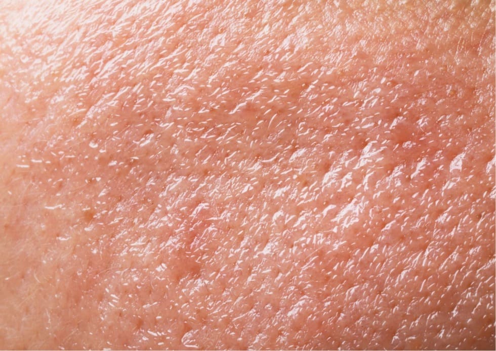 Primer plano de una piel grasa sin tratar 